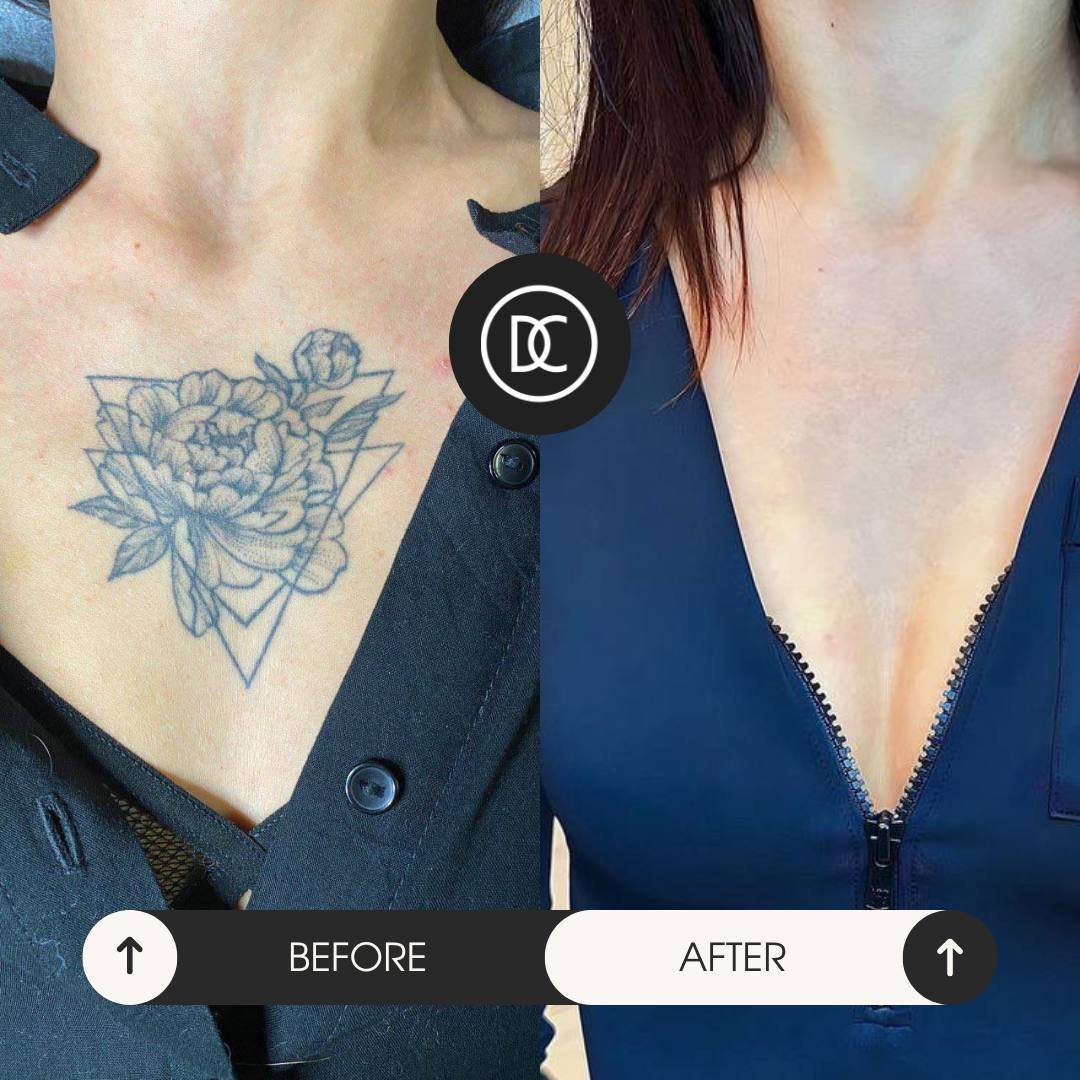 Приклад результатів до/після видалення тату